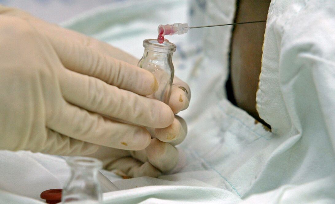 Extracción de sangre de médula ósea. Foto: EFE, archivo 
