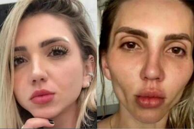 “Mi cara se cayó, no reconozco mi rostro”, influencer lamenta bichectomía