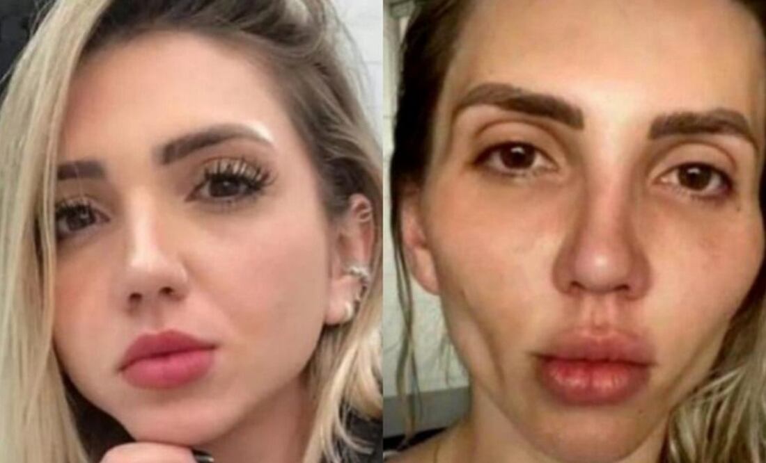 Los tratamientos estéticos deben tomarse con seriedad / Foto: Captura de video UOL Noticias