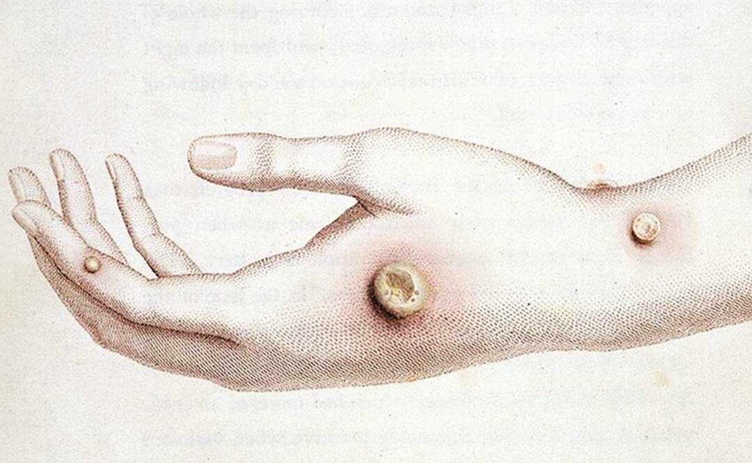 ¿Qué es viruela del mono o viruela símica y qué tan peligrosa es?