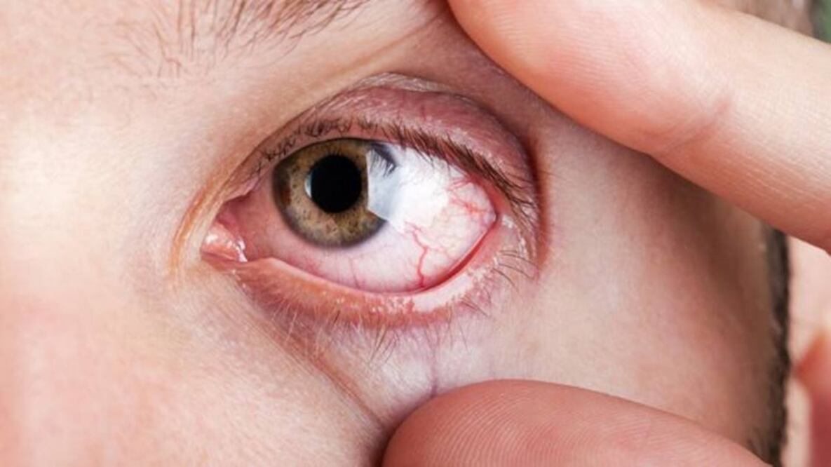La disputa se da por una medicamento para tratar los ojos resecos (Foto: Getty)