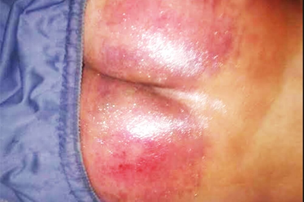 En redes sociales circuló la imagen de las lesiones que sufrió José Manuel Martínez en los glúteos por parte de policías (TOMADA DE REDES SOCIALES)