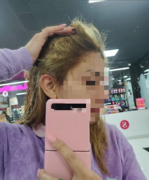Decoloración fallida: quemaron su pelo y su denuncia se hizo viral