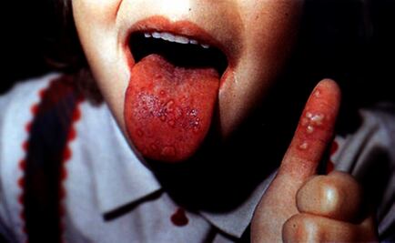 Se elevan a 143 los casos del virus coxsackie en Oaxaca