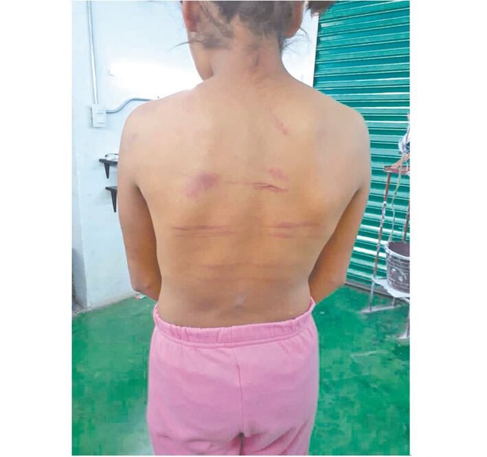 La niña presenta heridas en la espalda, glúteos y piernas, causadas por un cable o vara. Foto: ESPECIAL