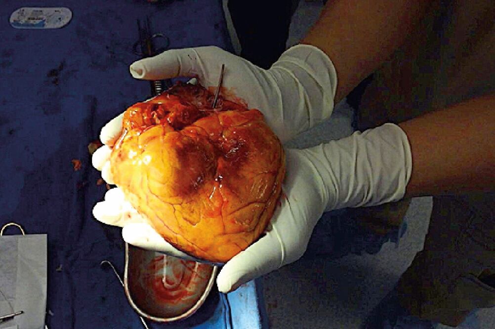 Los receptores de los órganos fueron una mujer de 50 años de edad con cardiopatía y un hombre de 38 años con cirrosis (MSS)