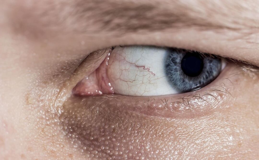 Prevención del glaucoma. Fuente: Pixabay