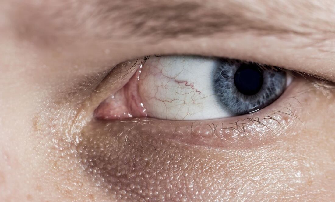 Cofepris recomienda no adquirir Lumigan (bimatoprost) solución 0.03% con los números de lote y fechas de vencimiento antes mencionados para el glaucoma. Fuente: Pixabay