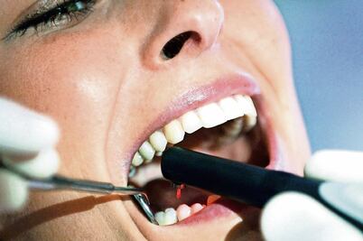 Cáncer bucal: cada vez más frecuente en jóvenes