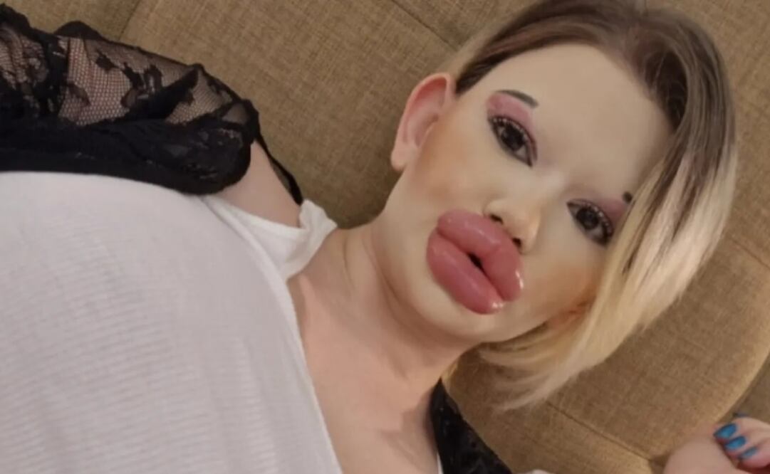 Andrea Ivanova recurrió a decenas de inyecciones de ácido hialurónico. Foto: Jam Press 