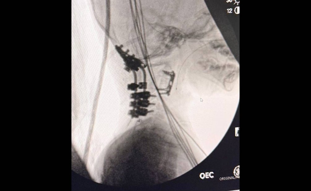 La operación realizada en Chicago volvió a unir la cabeza de Oliver con su médula espinal y columna. Foto: Cortesía Familia Staub-García