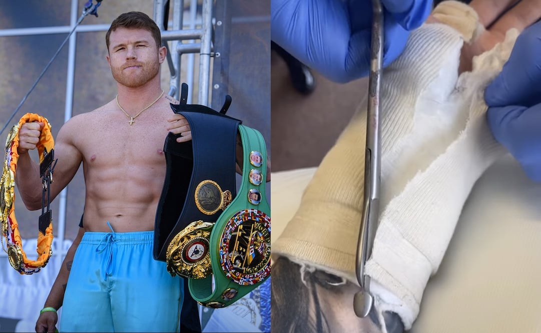 Canelo Álvarez se sometió a una cirugía en su mano izquierda - FOTO: Especial