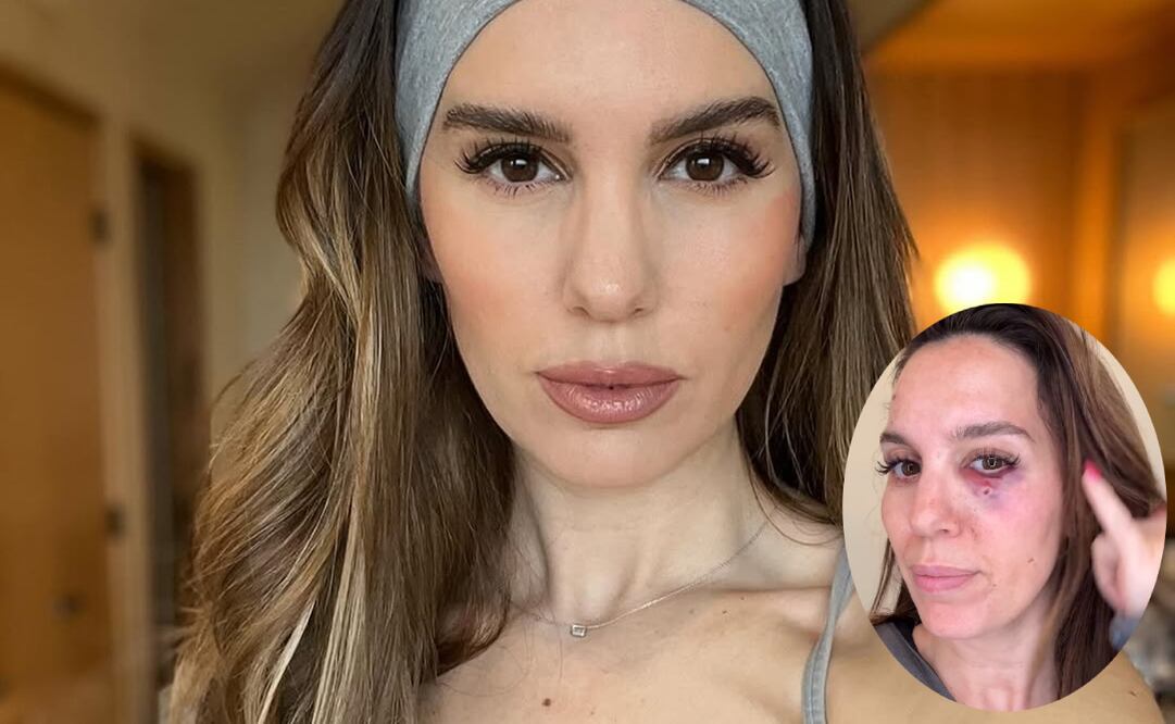 Christy Carlson preocupó a sus fans por sus lesiones. Foto: Instagram