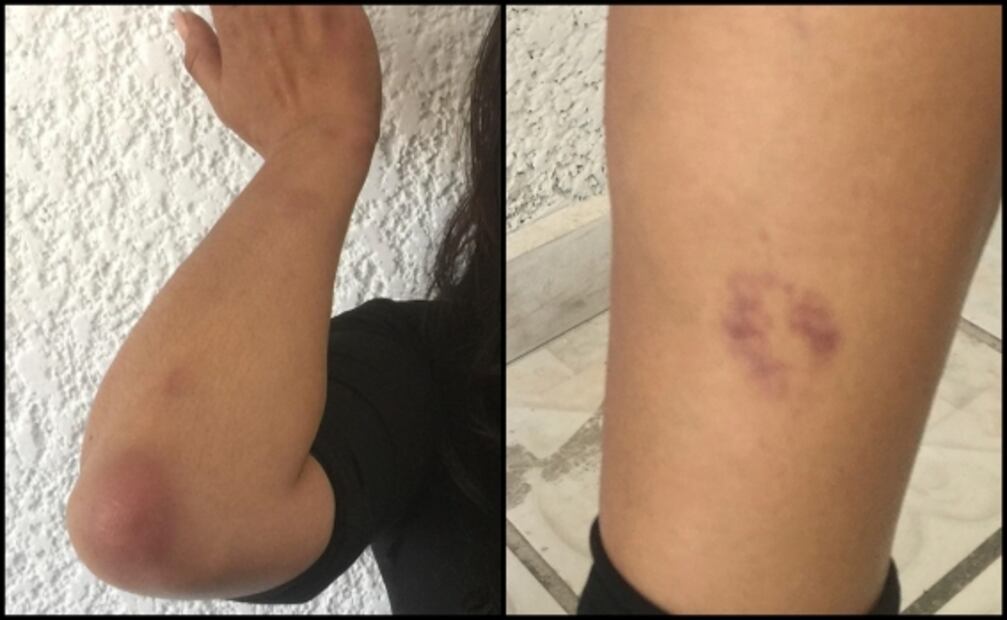 Periodista acusa golpiza de policías al denunciar intento de violación en Morelia