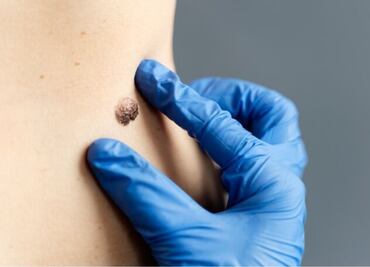 La planta medicinal que combate las verrugas causadas por el virus del papiloma humano (VPH)