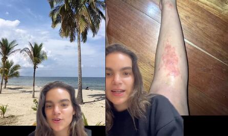 Se le metió un parásito por andar descalza en la playa; vivió una tortura