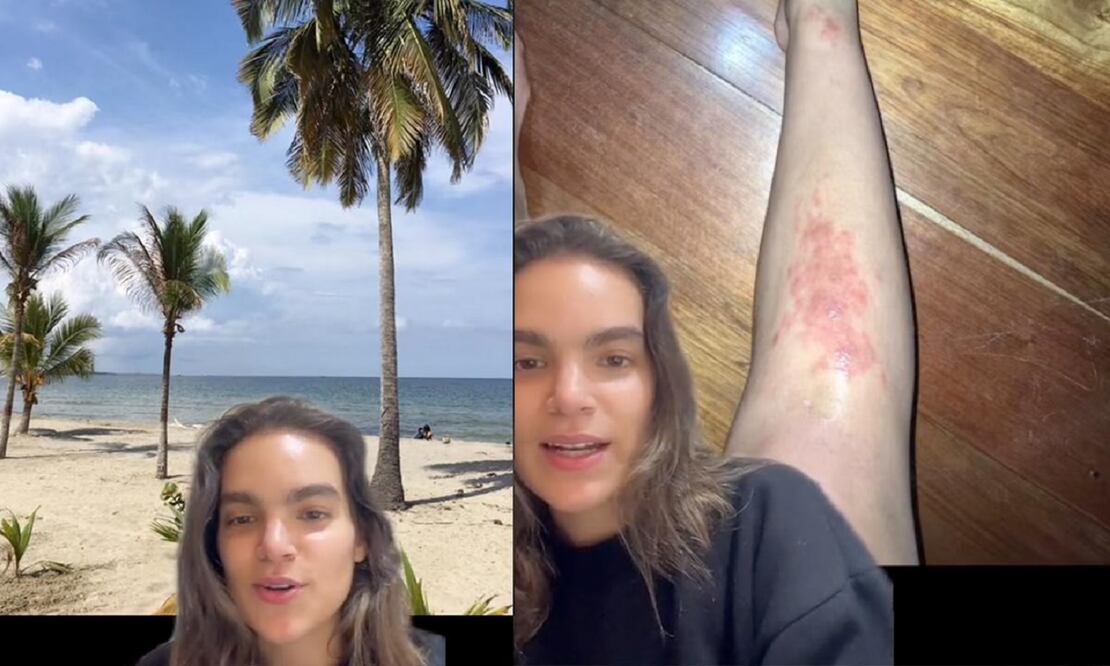 Estas son las imágenes que compartió una mujer sobre cómo se vio afectada su piel tra ir a la playa. FOTO: @doscabraslocas