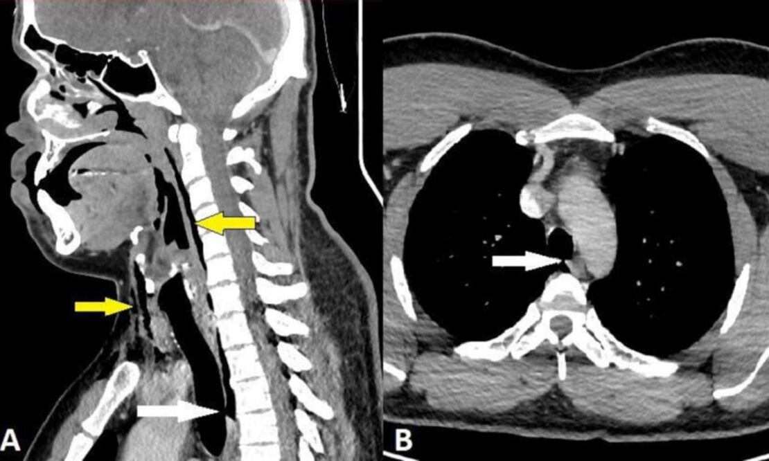 Una placa del paciente que se desgarró la traquea por intentar contener sus estornudos. FOTO: Spontaneous tracheal perforation following a sneeze - BMJ Case Reports