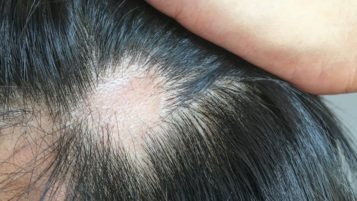 La caída del cabello causada por el coronavirus suele ser temporal. Foto: Getty Images vía BBC