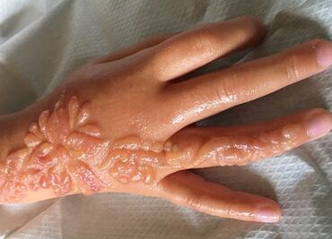 Tatuaje de henna causa graves quemaduras a niña y le deja cicatriz permanente