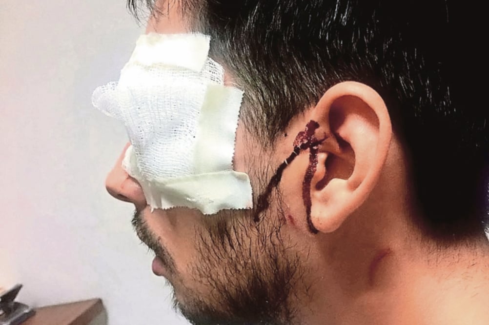 El joven resultó con lesiones en el oído, ojo izquierdo, pómulo y nariz, por lo que tuvo que ser atendido por socorristas de la Cruz Roja. (CORTESÍA MAURICIO MAYORGA)