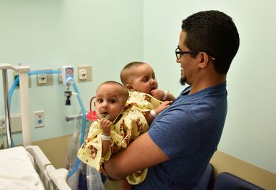 Médicos de NY separan a siamesas dominicanas