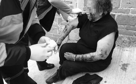 Perros atacan a mordidas a adulta mayor en Toluca