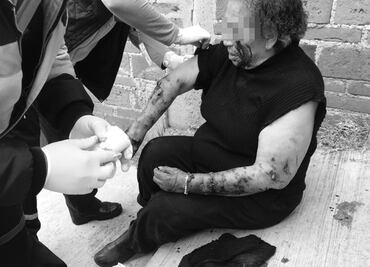 Perros atacan a mordidas a adulta mayor en Toluca