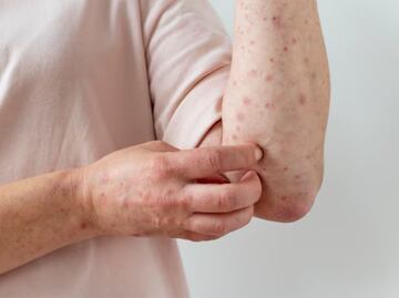 Brote de sarampión en Texas deja primer muerto; es un menor de edad