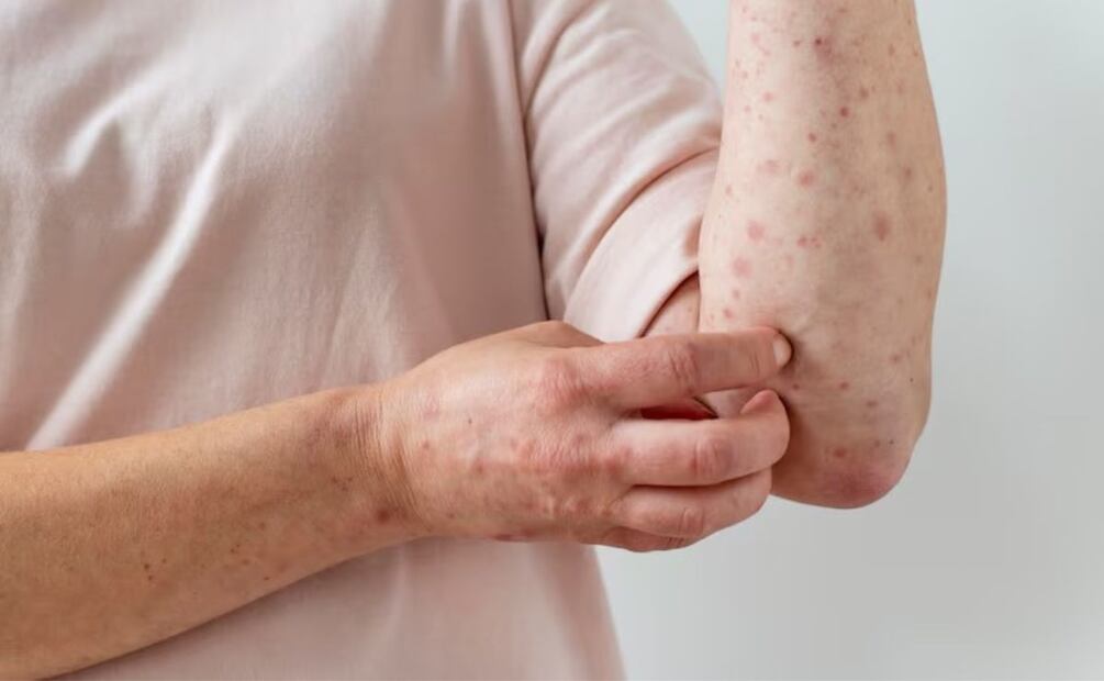 Snack contra el sarampión. Fuente: Freepik