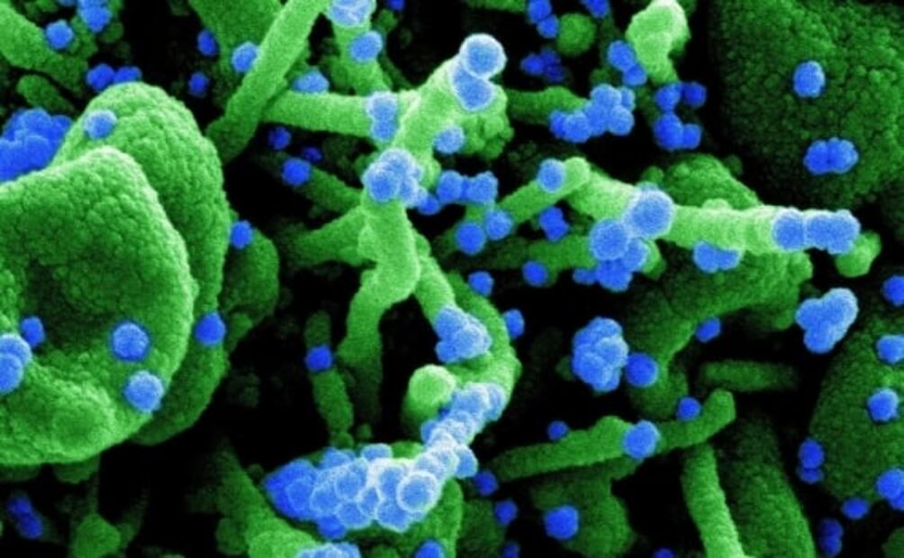 Anticuerpos del SARS de 2003 neutralizan limitadamente al Covid-19: estudio