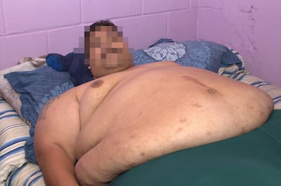 Operarán en Guadalajara al hombre más obeso del mundo