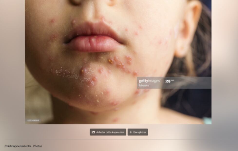 ¿Cubrebocas contra el Covid pueden causar enfermedades en la piel? 