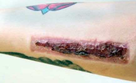 'Cutting', la peligrosa moda entre jóvenes de Chimalhuacán