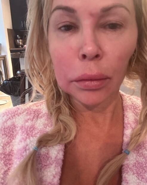 Brandi Glanville compartió esta foto de su rostro. No le han dado un diagnóstico y está desesperada.