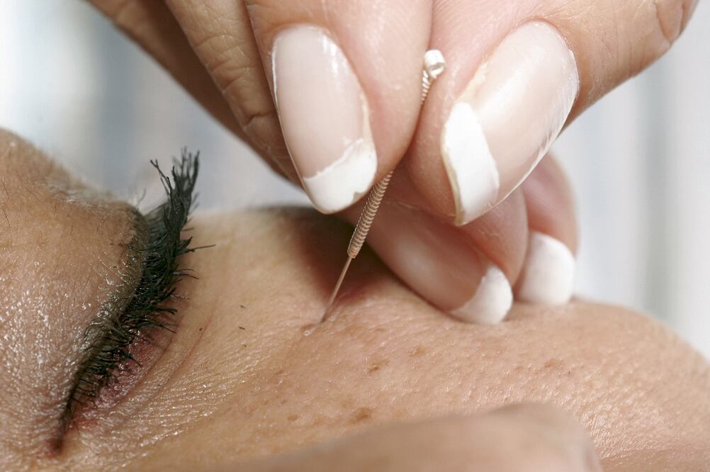 Persona utilizando terapia de acupuntura. Foto: El Universal/ Braulio Tenorio, archivo 