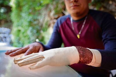 Tras incendio en Cd. Juárez, disculpa no sana sus heridas; “respirar me lastima”, dice migrante 