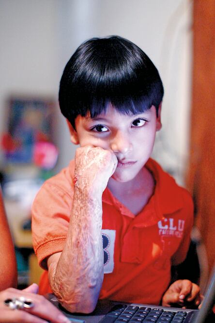 Lo reportaron grave; estuvo delicado por quemaduras con mayores afectaciones en sus brazos, manos, piernas, una parte de la espalda y su cabeza ()