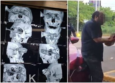 Pierde el ojo hombre acuchillado por pelear cajón de estacionamiento