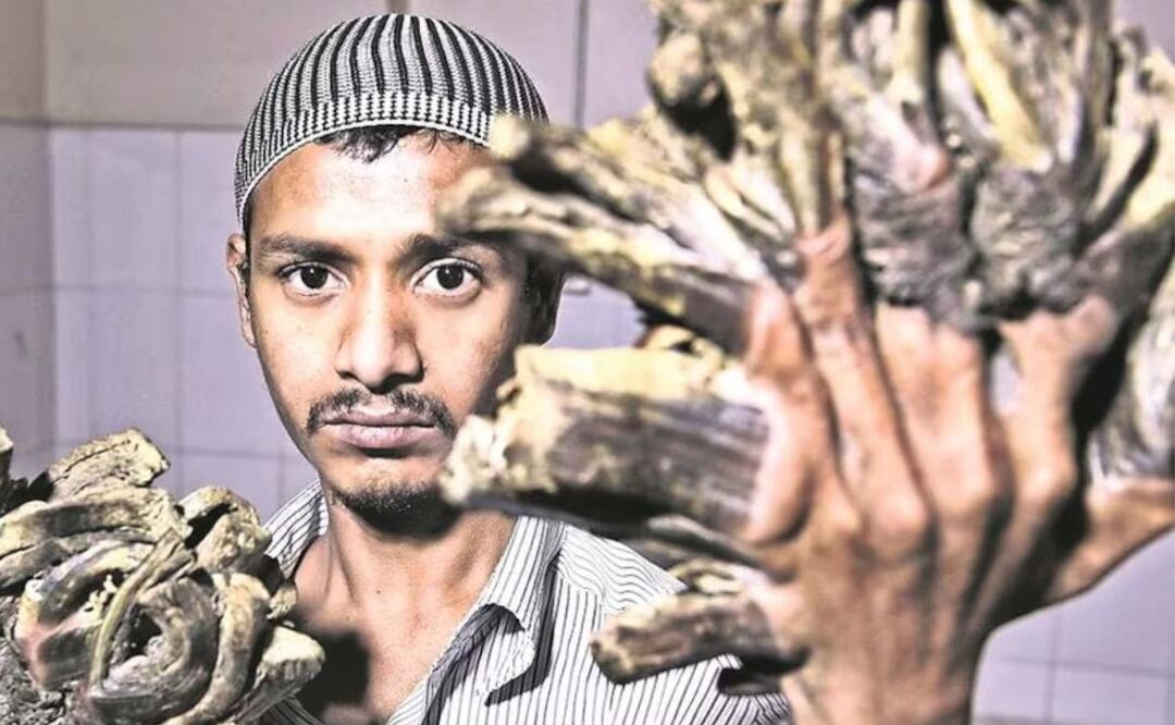 Cómo es el síndrome del hombre árbol. Fuente: Archivo El Universal (EFE)