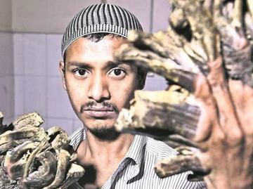 ¿Cómo es el síndrome del hombre árbol?; conoce la enfermedad que afecta a la piel