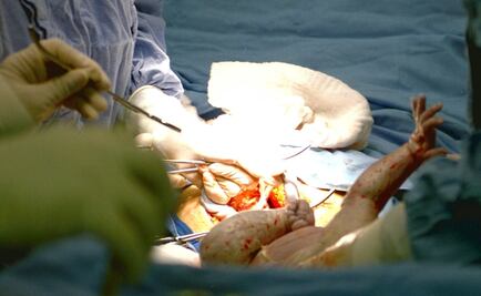 Las cesáreas ha alterado la evolución humana