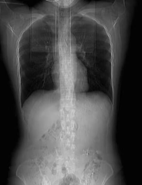 Mujer se fractura cuatro costillas tras un ataque de tos