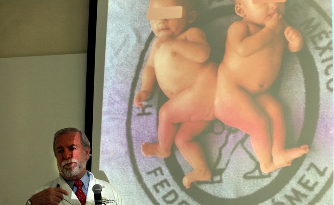 Expertos del hospital señalaron que el riesgo de esta cirugía era que las bebés quedarán parapléjicas o que fallecieran. /Valente Rosas - EL UNIVERSAL