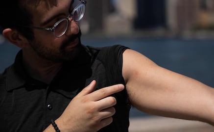 "Los peores dolores de mi vida": neoyorquino cuenta cómo fue tener viruela del mono