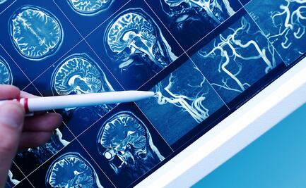 Demencia: ladrón de recuerdos