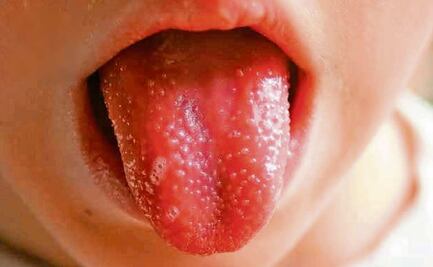 Enfermedad de Kawasaki: rara, pero de cuidado en niños pequeños