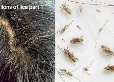 VIDEO: Una niña infestada de piojos aterroriza a usuarios en EU