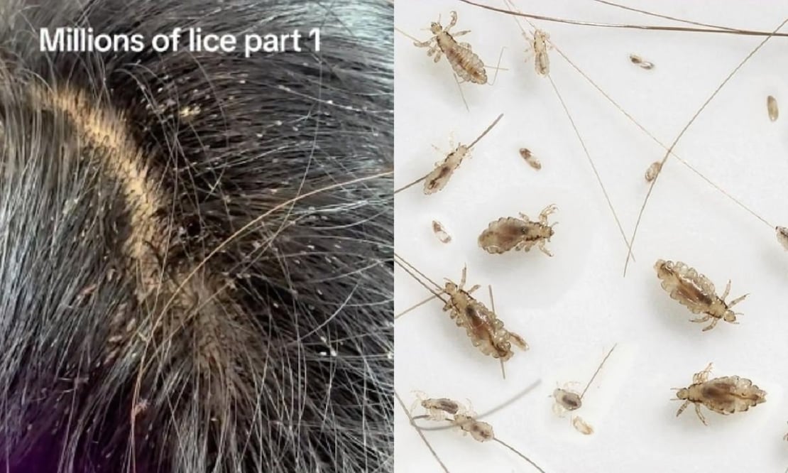 Una menor fue sometida a cuatro procesos capilares para eliminar los piojos. FOTO: TikTok:@theliceangels