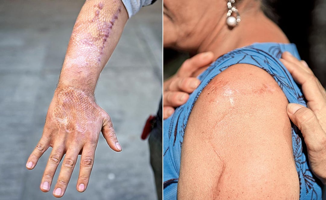 El brazo de Yolanda fue arrancado de su torso cuando fue atropellada y el de José Jairo quedó prensado en una máquina, a través de una cirugía ambos han logrado conservar sus extremidades (Foto: Jorge Alberto Mendoza)